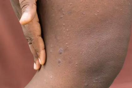 skin condition
