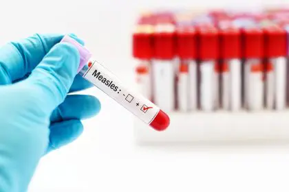 Dangerous measles case