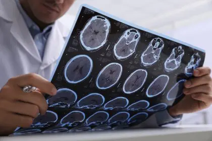 multiple sclerosis, MS, brain, living