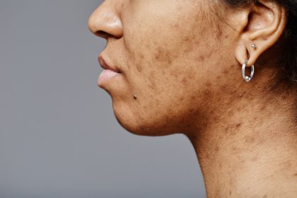 Why neck acne