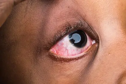 ease pink eye discomfort
