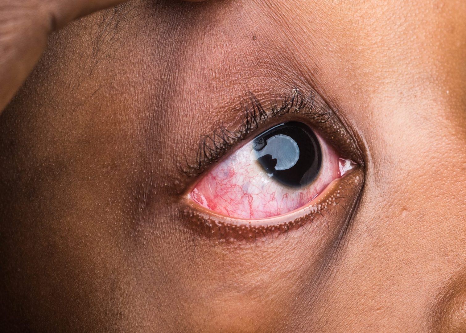 ease pink eye discomfort