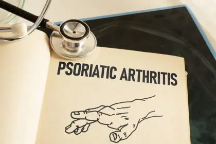 Psoriatic, Arthritis, hand, health
