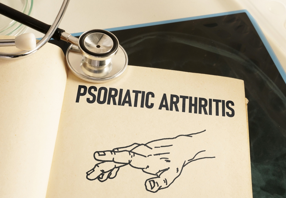 Psoriatic, Arthritis, hand, health