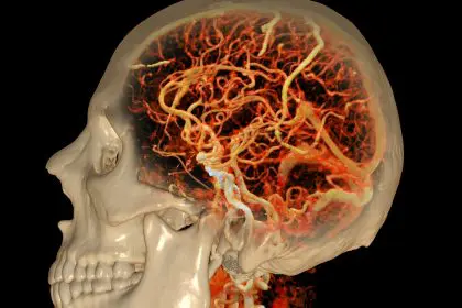 Brain blood clot