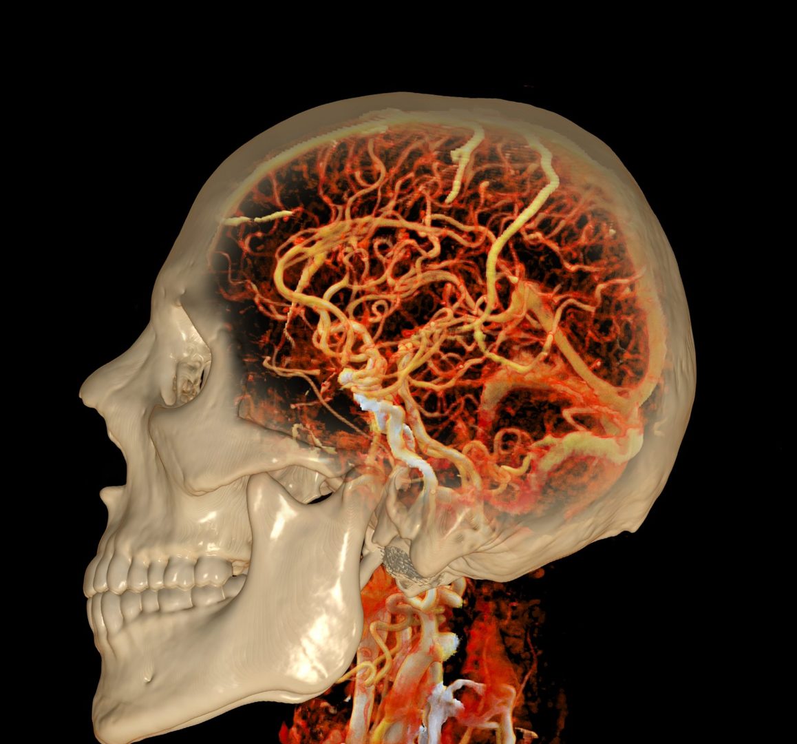 Brain blood clot