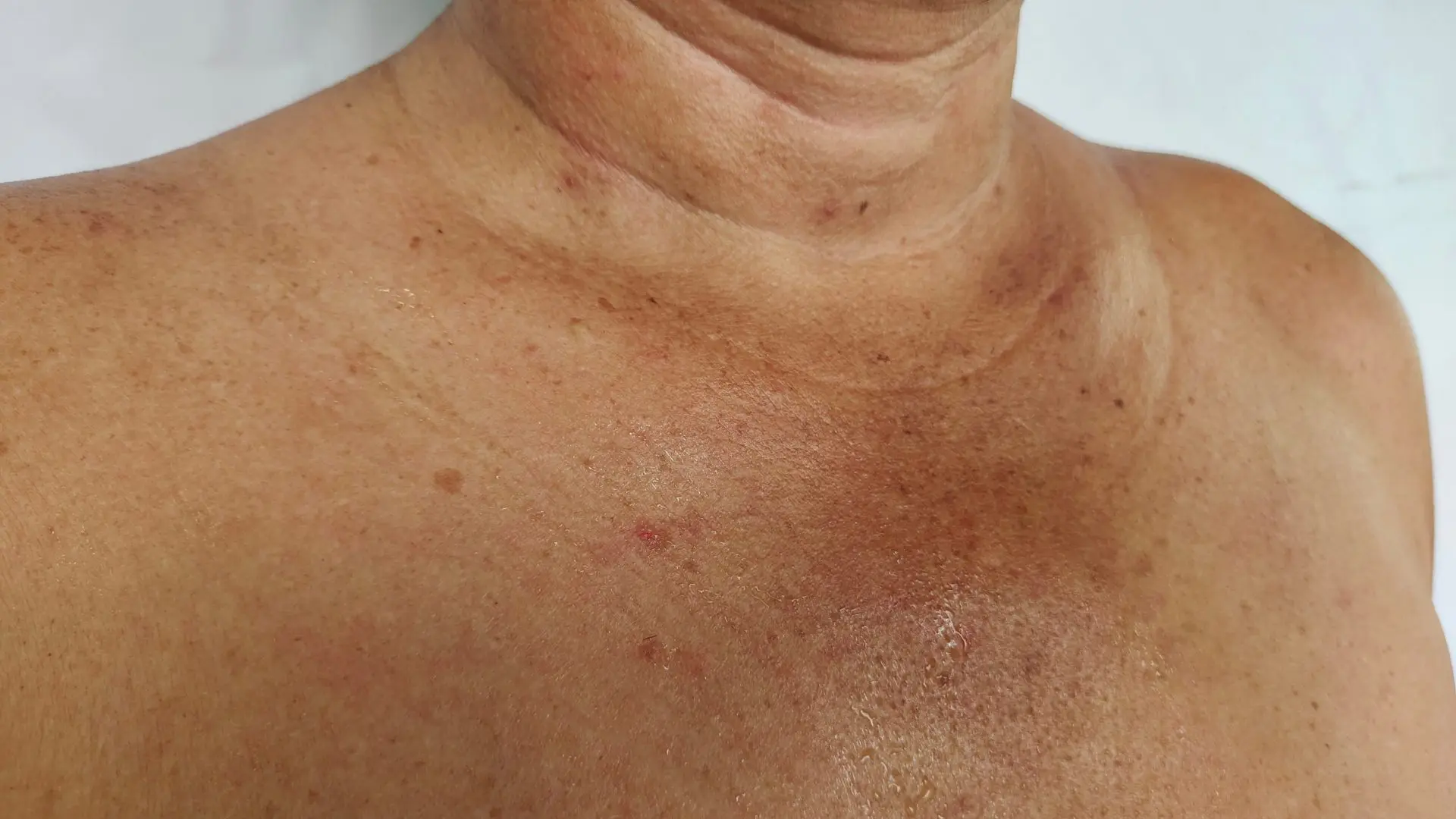5 harmless skin spots
