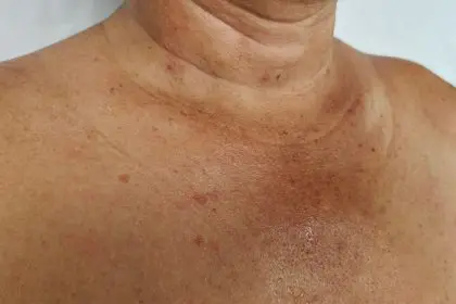 5 harmless skin spots
