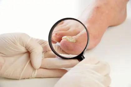 nails, fungal nail infection