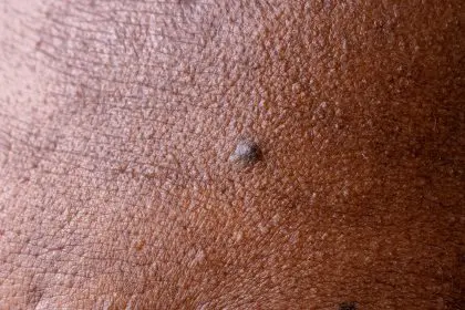 mole warning signs that could save your life